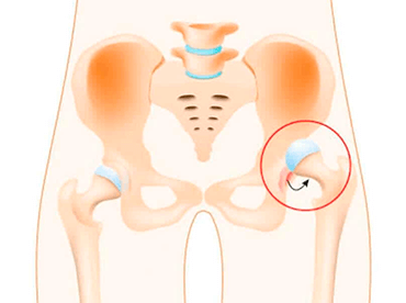 Luxação Congênita do Quadril